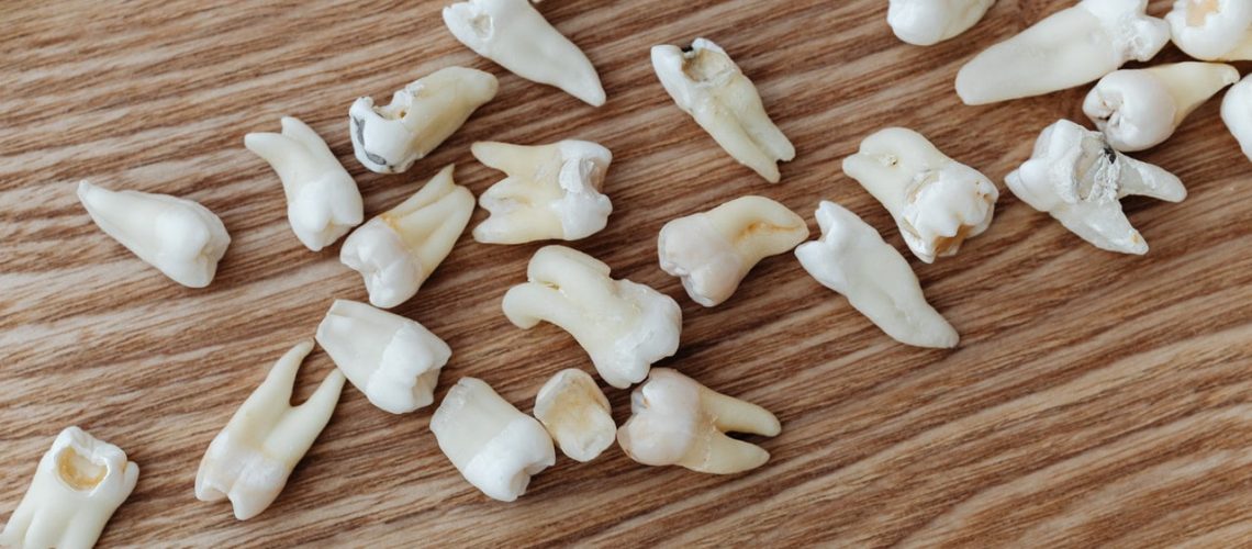 At What Stage of Decay do Teeth Begin to Fall Out?