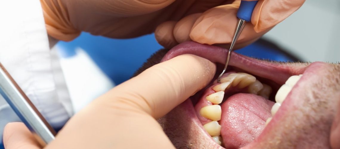 Can Gum Disease Cause Heart Disease?
