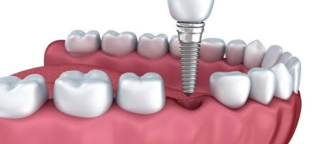 Can I Get Dental Implants if I Have Diabetes?