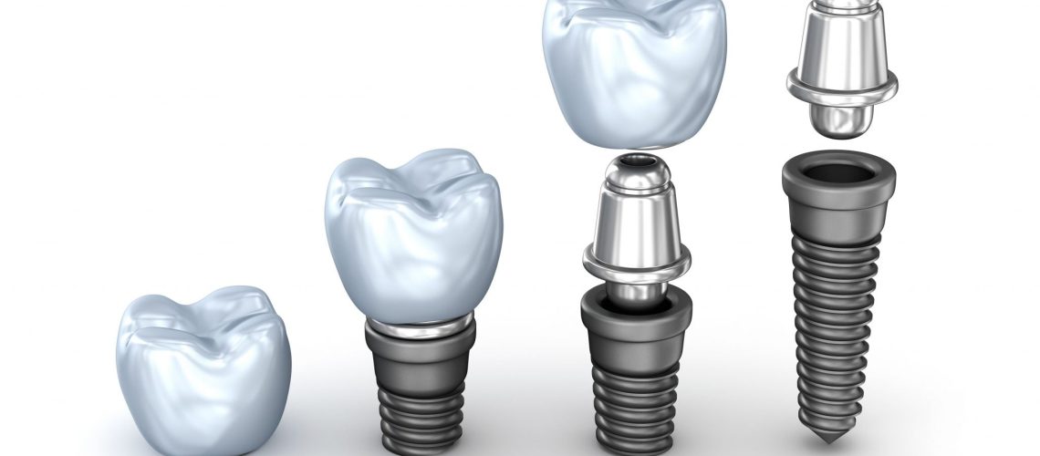 Is it Better to Get A Dental Implant or a Bridge?