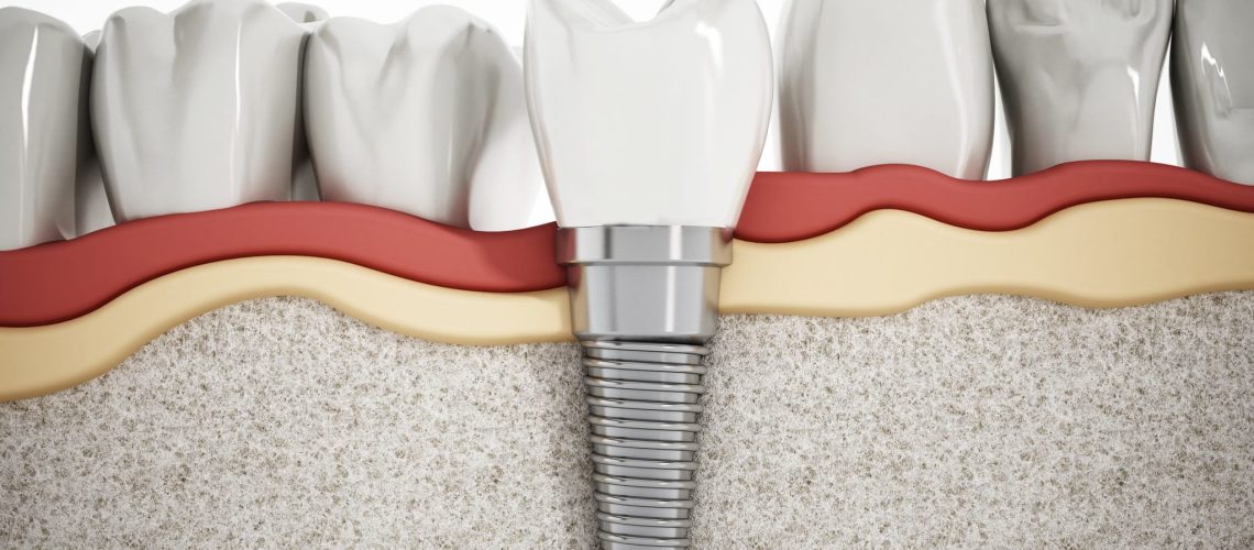 Who is a good candidate for dental implants?