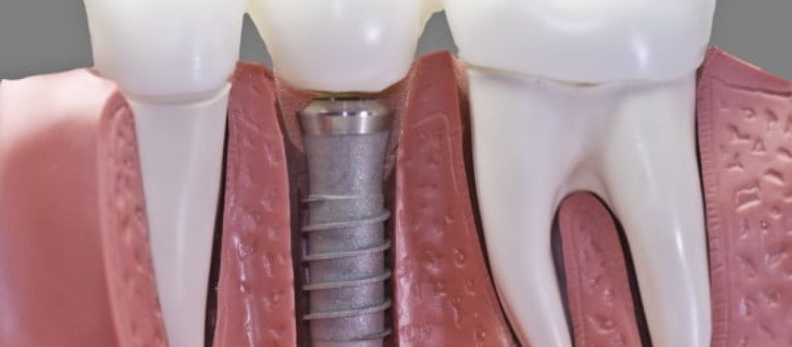 What are the pros and cons of dental implants?