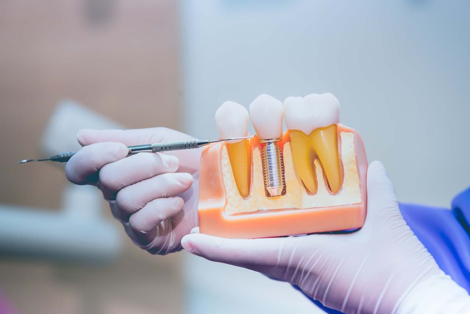 What Do Dental Implants Look Like?