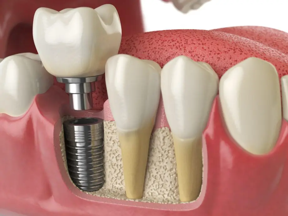 Can Medications Cause Dental Implants to Fail? What Denver Residents Need to Know